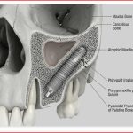 Perché il tuo dentista a Milano non ti dà denti fissi in 2 ore? Perché non conosce l’osso basale.