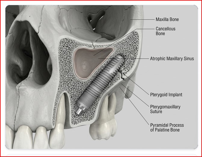 Perché il tuo dentista a Milano non ti dà denti fissi in 2 ore? Perché non conosce l’osso basale.