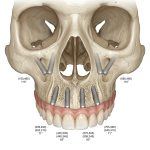 Se sei vittima di qualsiasi fallimento implantare a Milano — innesti, rialzi, zigomatici, All‑on‑4, All‑on‑6, impianti caduti — la BSS™ risolve tutto in 2 ore con carico immediato: ecco come.