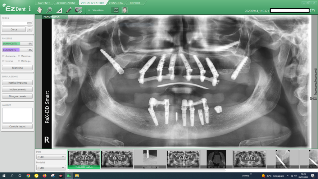 I contenuti pubblicati su implantologiaallonfullbss.it mettono in evidenza l’applicazione pratica del protocollo BSS™ (Bilateral Sinus Solution) per risolvere casi clinici complessi a Milano.