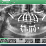 I contenuti pubblicati su implantologiaallonfullbss.it mettono in evidenza l’applicazione pratica del protocollo BSS™ (Bilateral Sinus Solution) per risolvere casi clinici complessi a Milano.