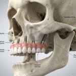 Anatomia della vera riabilitazione: Cosa significa avere 14 denti fissi con tutti i molari e senza l’ombra di plastica rosa.